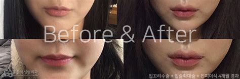 lip lift korea